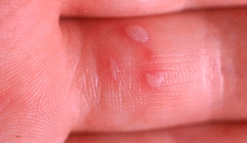 Síndrome mano-pie-boca o enfermedad de Coxsackie