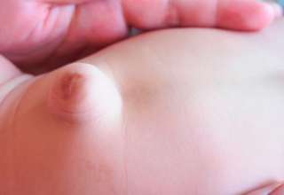 Cuatro preguntas y respuestas sobre la hernia umbilical en bebés