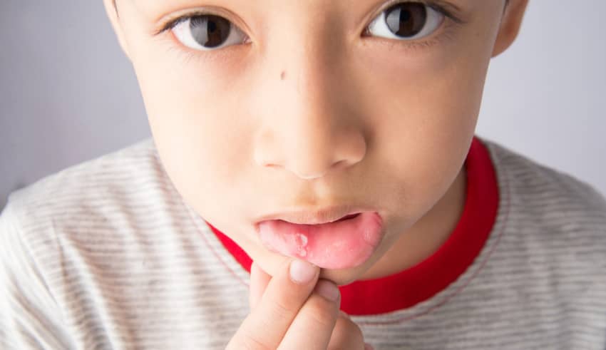 Úlceras y llagas en la boca del niño