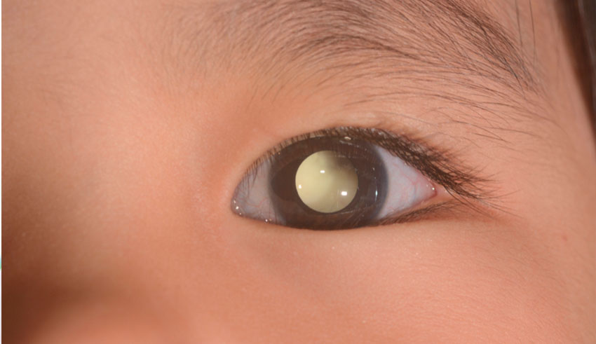 La causa principal de este tipo de enfermedad no tiene un origen específico, sin embargo, según la Clínica Clofán se puede afirmar que existe una mayor propensión de desarrollo a personas de piel blanca y ojos claros.