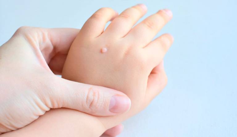 A Que Edad Aplicar La Vacuna Contra Vph En Niñas